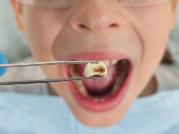 Best Emergency Tooth Extraction in Wilkinson Heights, SC